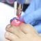 1 Sesión Láser Eliminación Onicomicosis